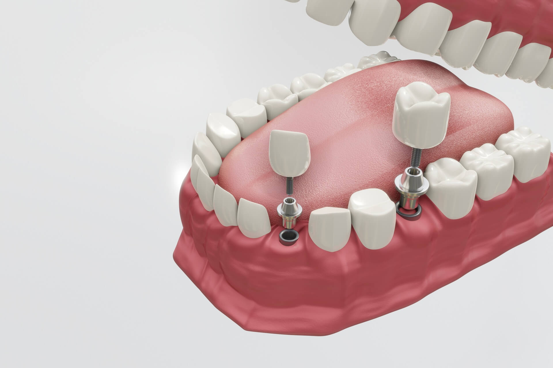 implant-03