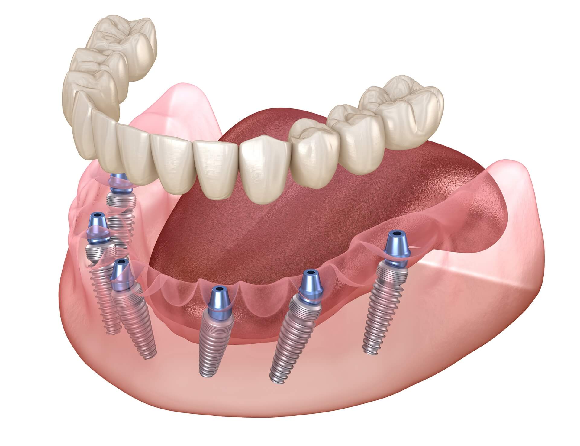 implant-05