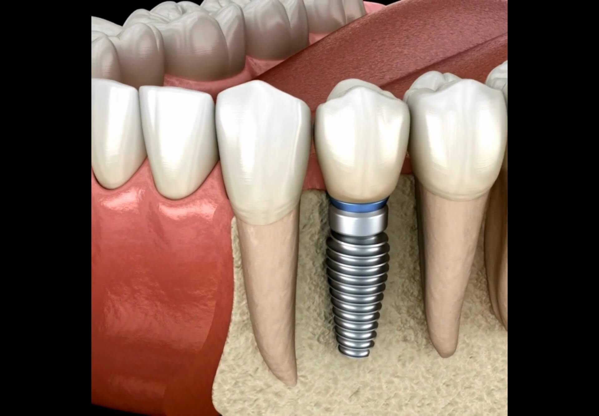 implant-07
